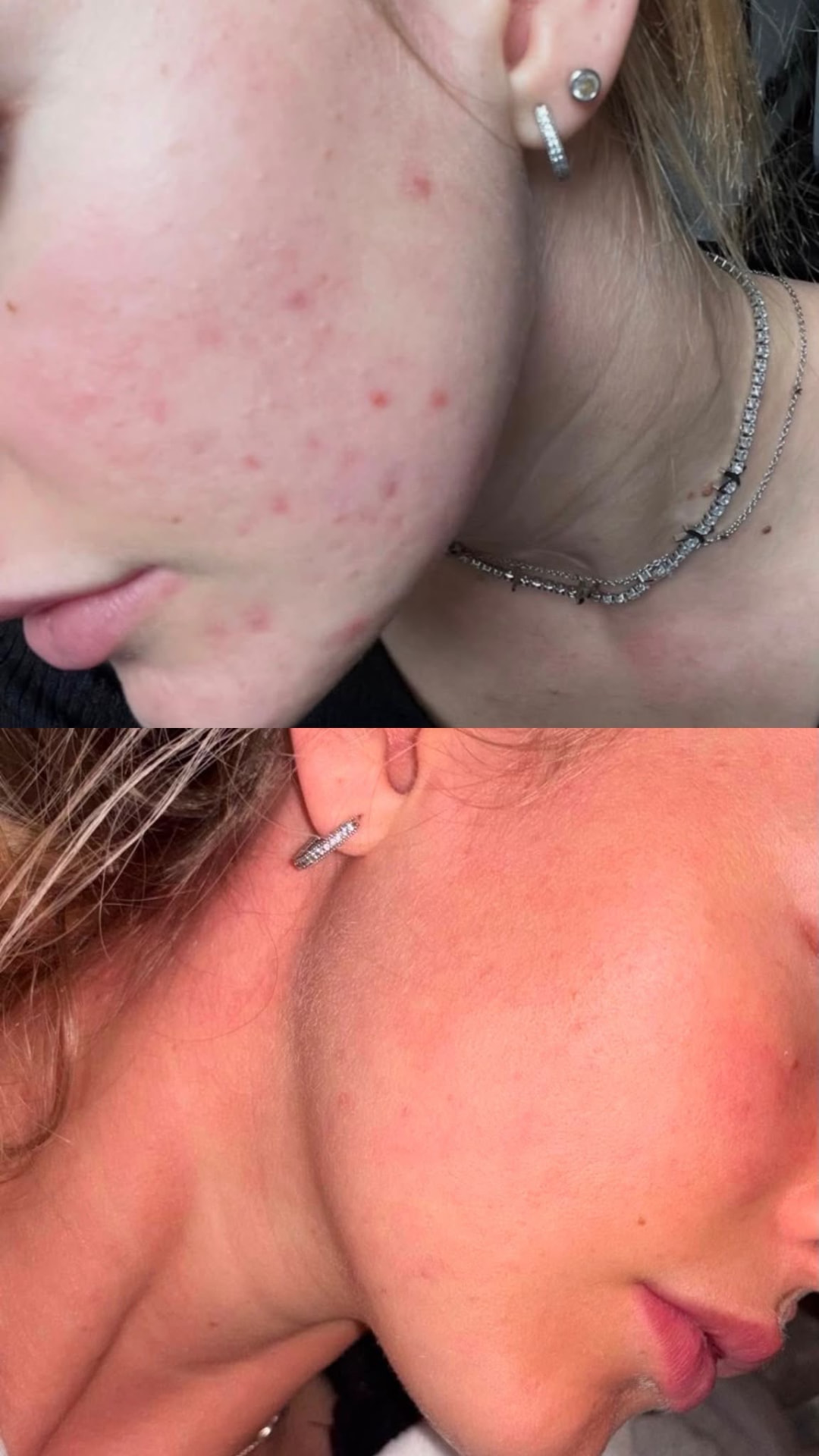 Before and after comparison showing acne treatment results on the cheek and jawline