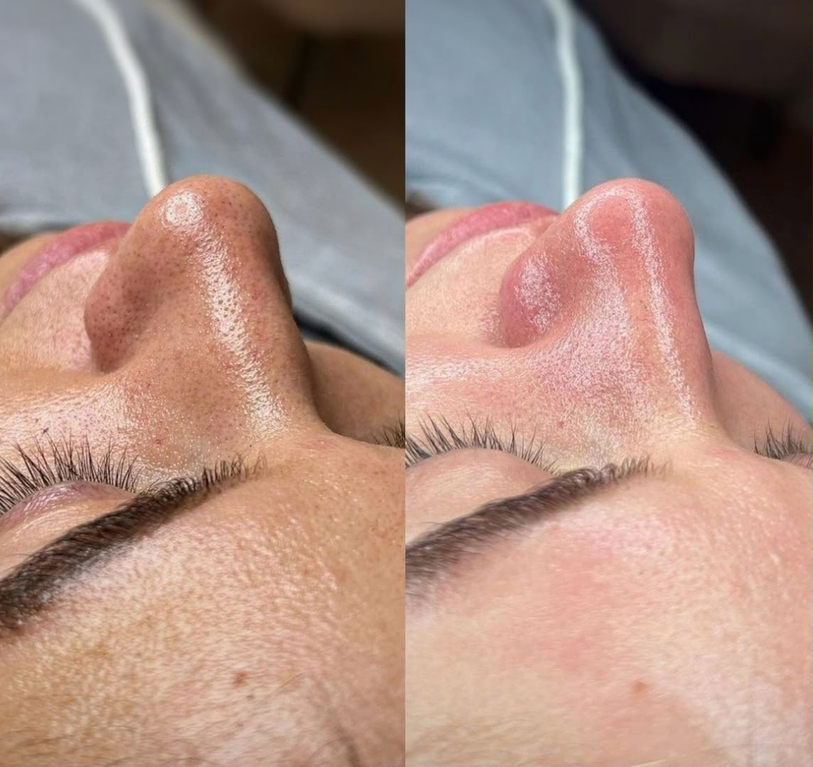 Side-by-side close-up showing facial skin treatment results