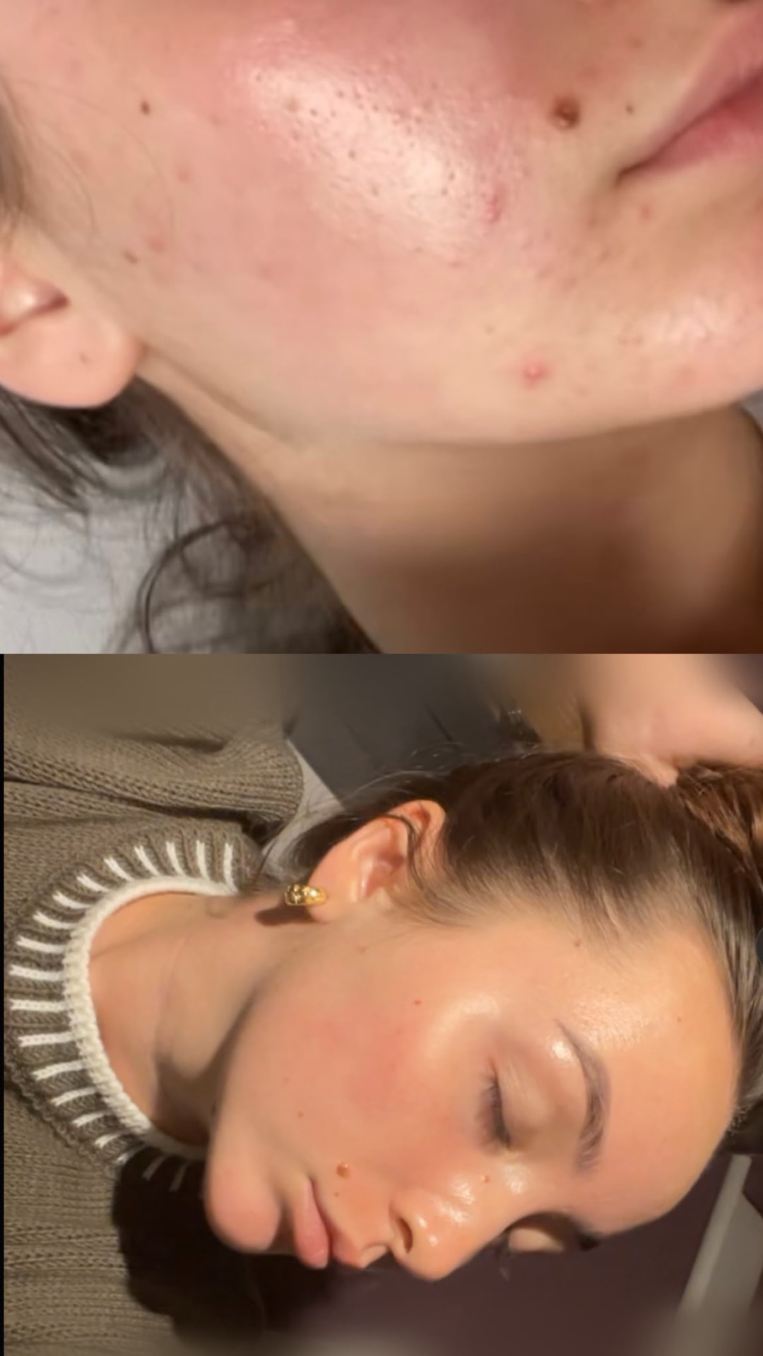 Close-up comparison showing blemishes and clearer-looking skin after treatment