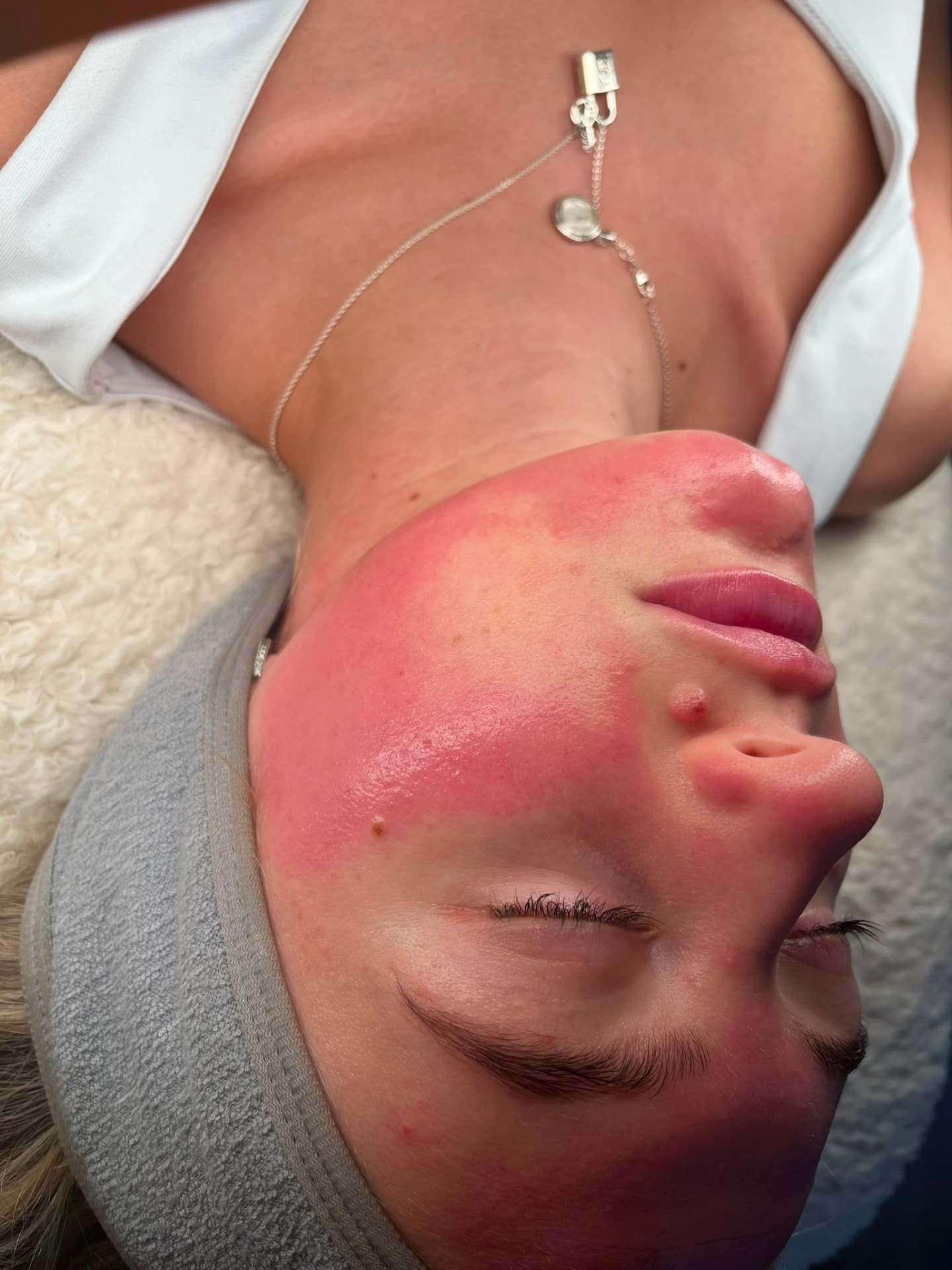 Client with temporary redness immediately after a professional facial treatment