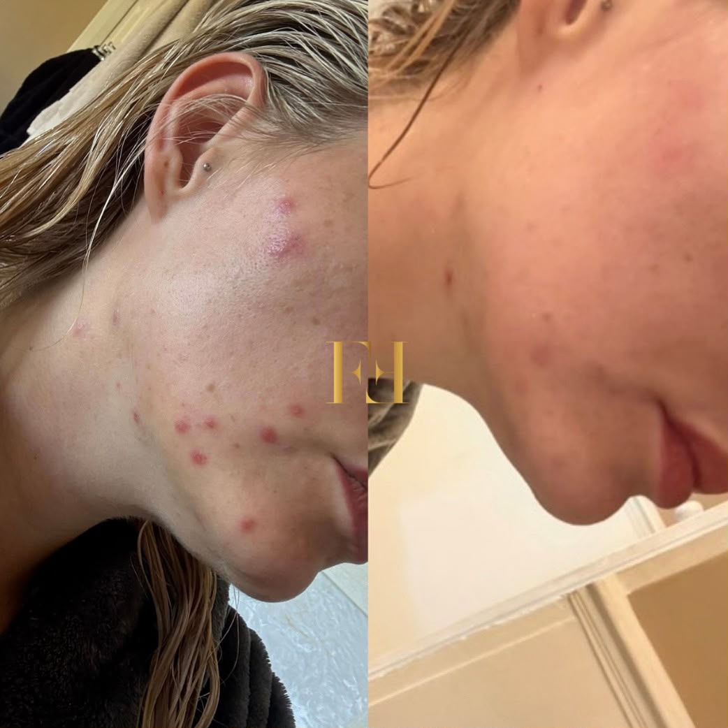 Before and after comparison of blemish-prone skin following a course of skin treatments