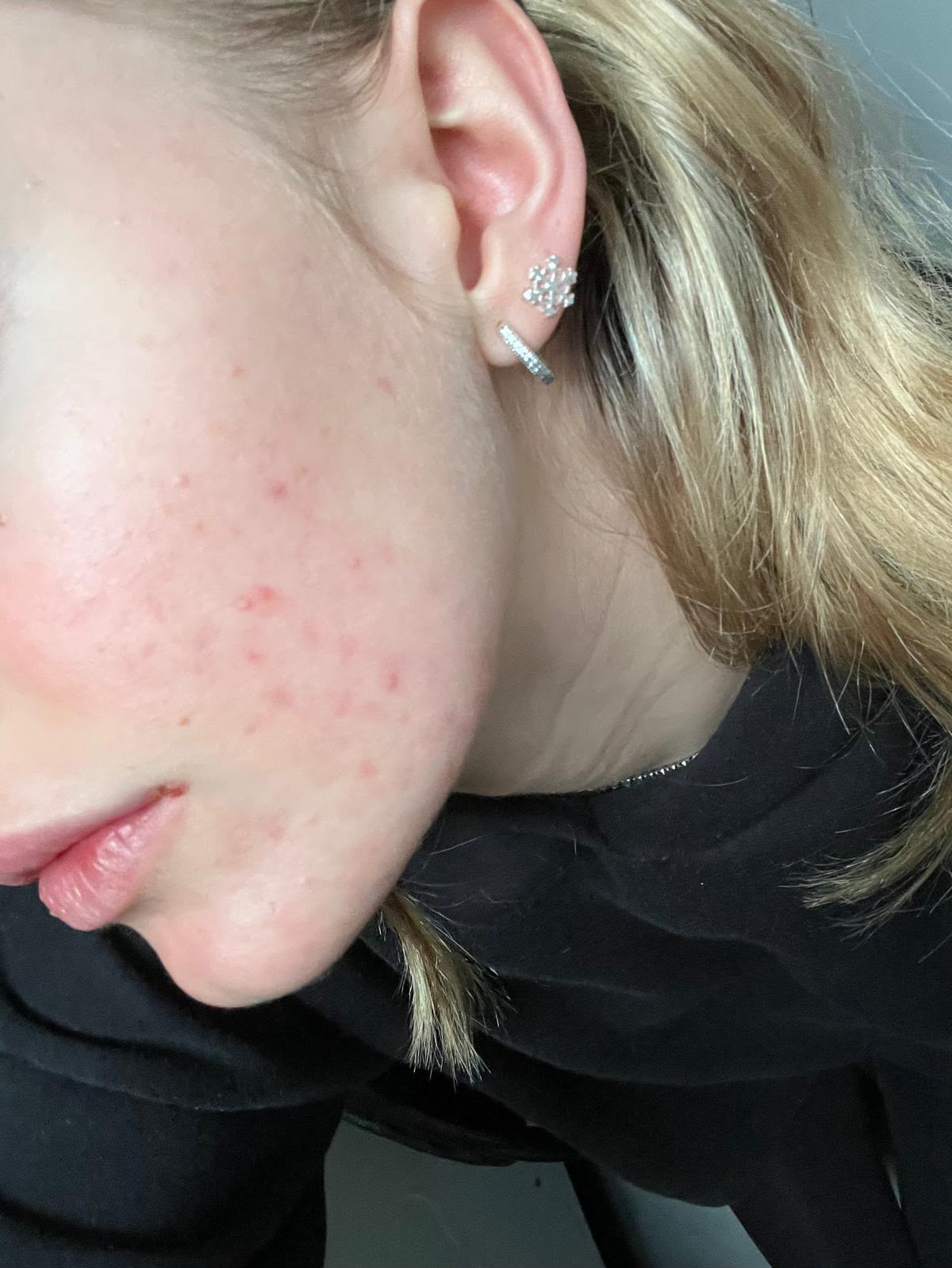Close-up of mild blemishes and redness on the cheek before skin treatment