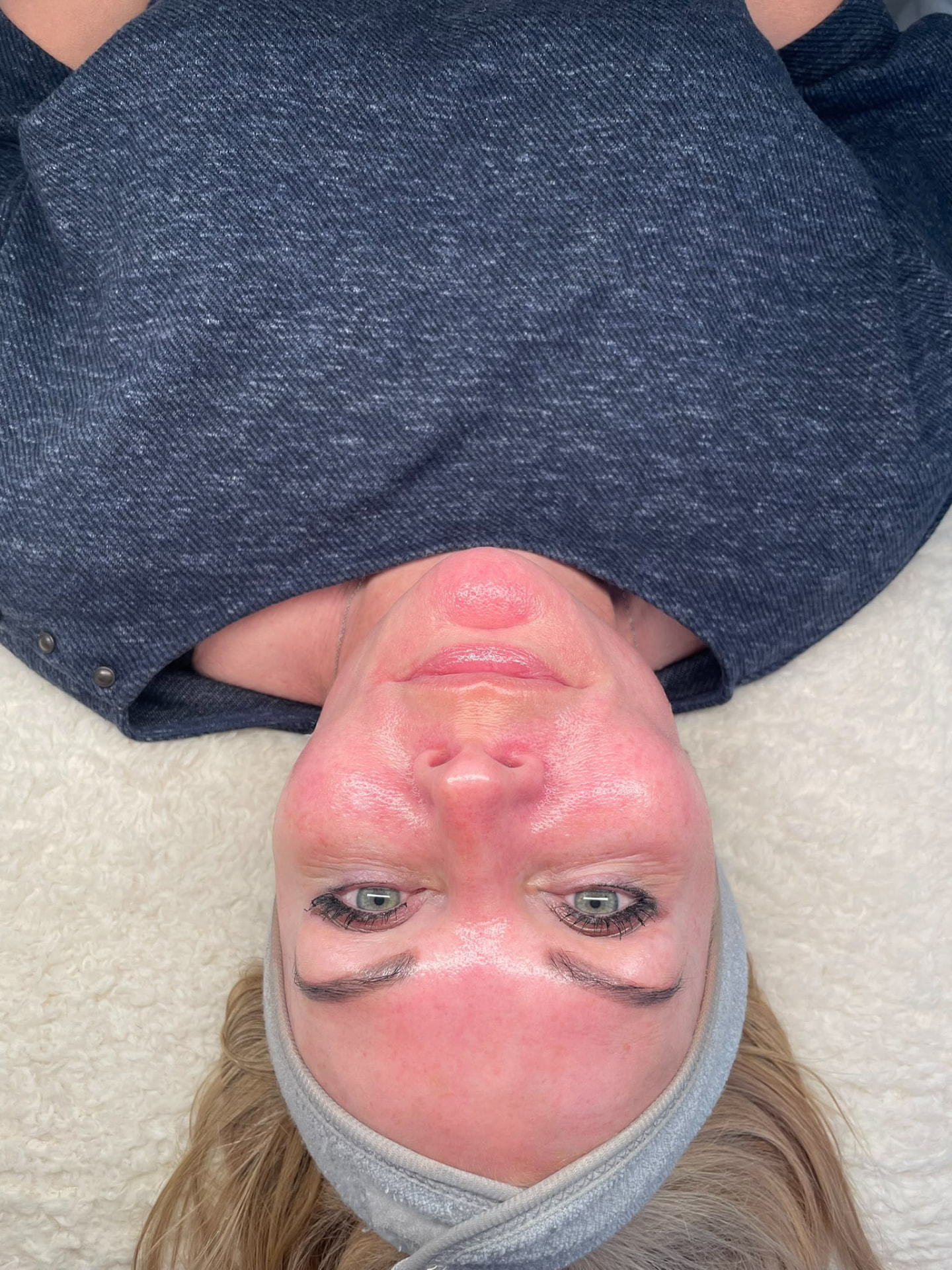 Client showing normal temporary redness across the face following a skin treatment